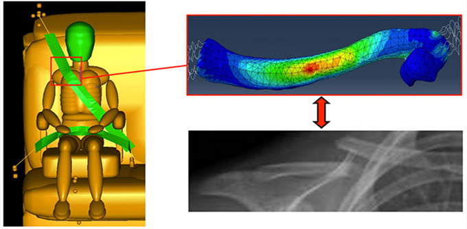 ClavicleFracturesDueToBeltLoading